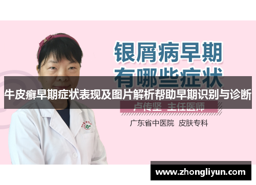 牛皮癣早期症状表现及图片解析帮助早期识别与诊断 牛皮癣早期症状表现及图片解析帮助早期识别与诊断